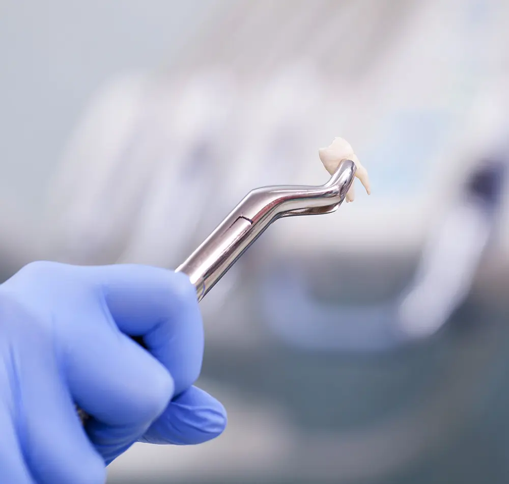 Tooth extraction