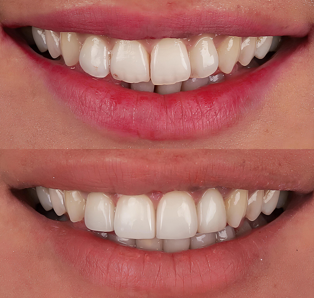 Porcelain veneers